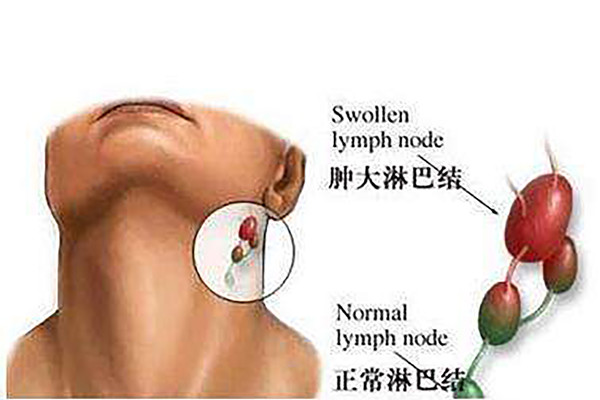 淋巴结核症状