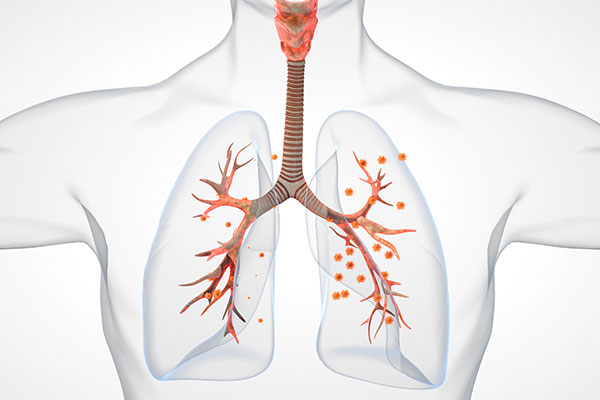 肺结核怎么治,肺结核能治好吗