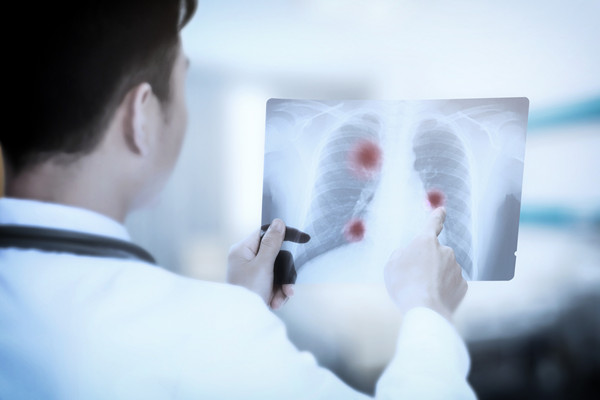 肺结核复发的原因是什么