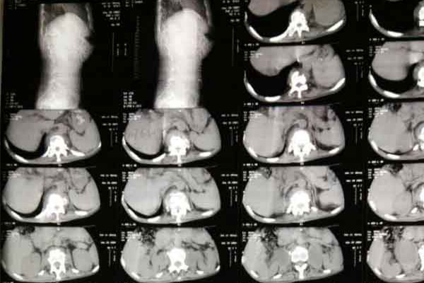 骨结核怎么治 骨结核怎么治