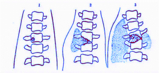 脊柱结核，你了解多少？