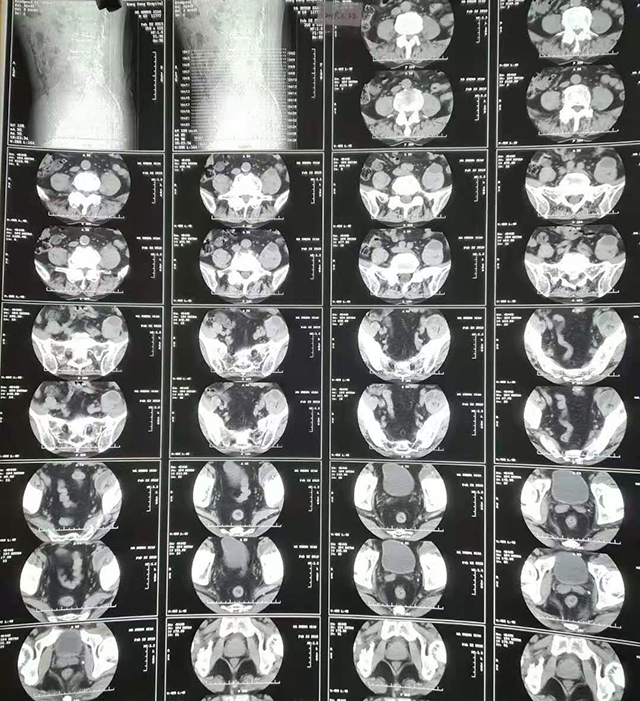 腰骶椎结核3.jpg
