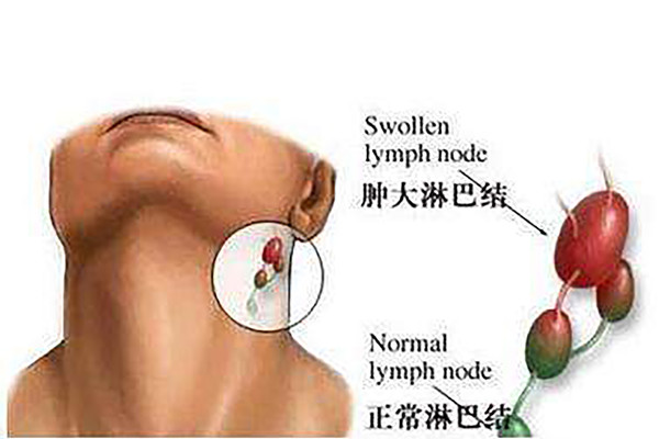 淋巴结核症状 淋巴结核症状