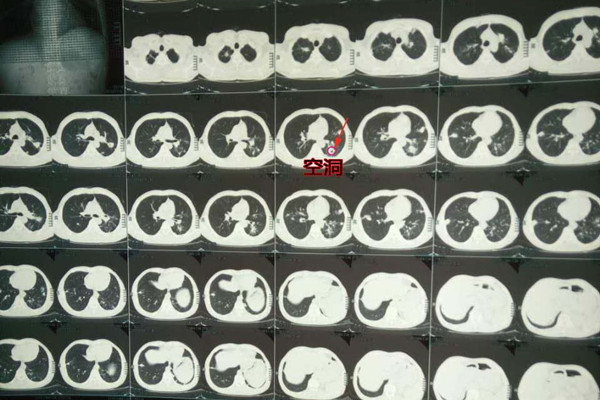 肺结核空洞怎么治疗 肺结核空洞怎么治疗