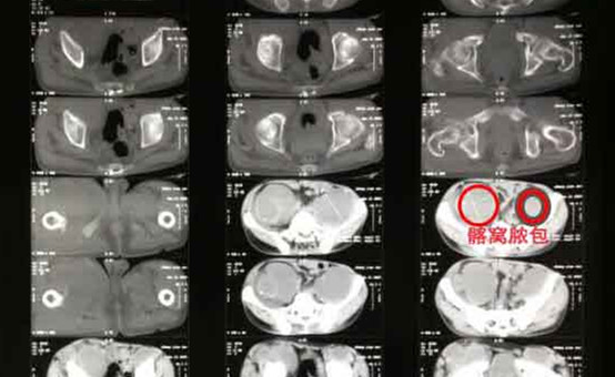 骨结核怎么治疗