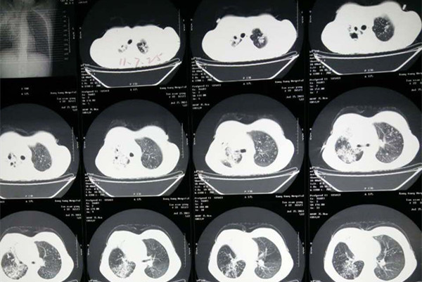 胸膜炎的早期症状ct图图片