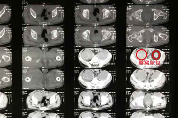 骨结核怎么治疗 骨结核怎么治疗