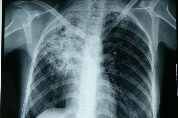 肺结核怎么确诊与治疗